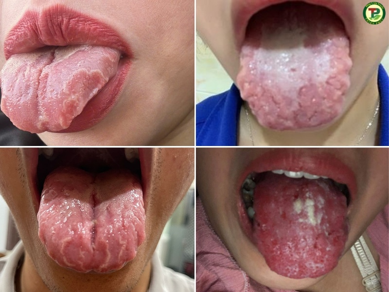 Nấm lưỡi bản đồ nặng